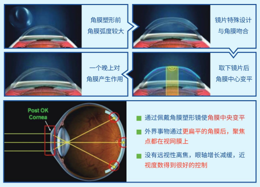 孩子近视怎么办？延缓度数加深！这种眼镜白天不用戴！插图